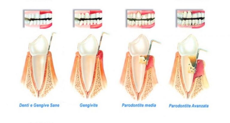 Agorà Medi | gengive parodontite