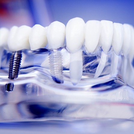 Poliambulatorio Privato Agorà Medi | Odontoiatria - Implantologia - implantologia dentale a Reggio Emilia