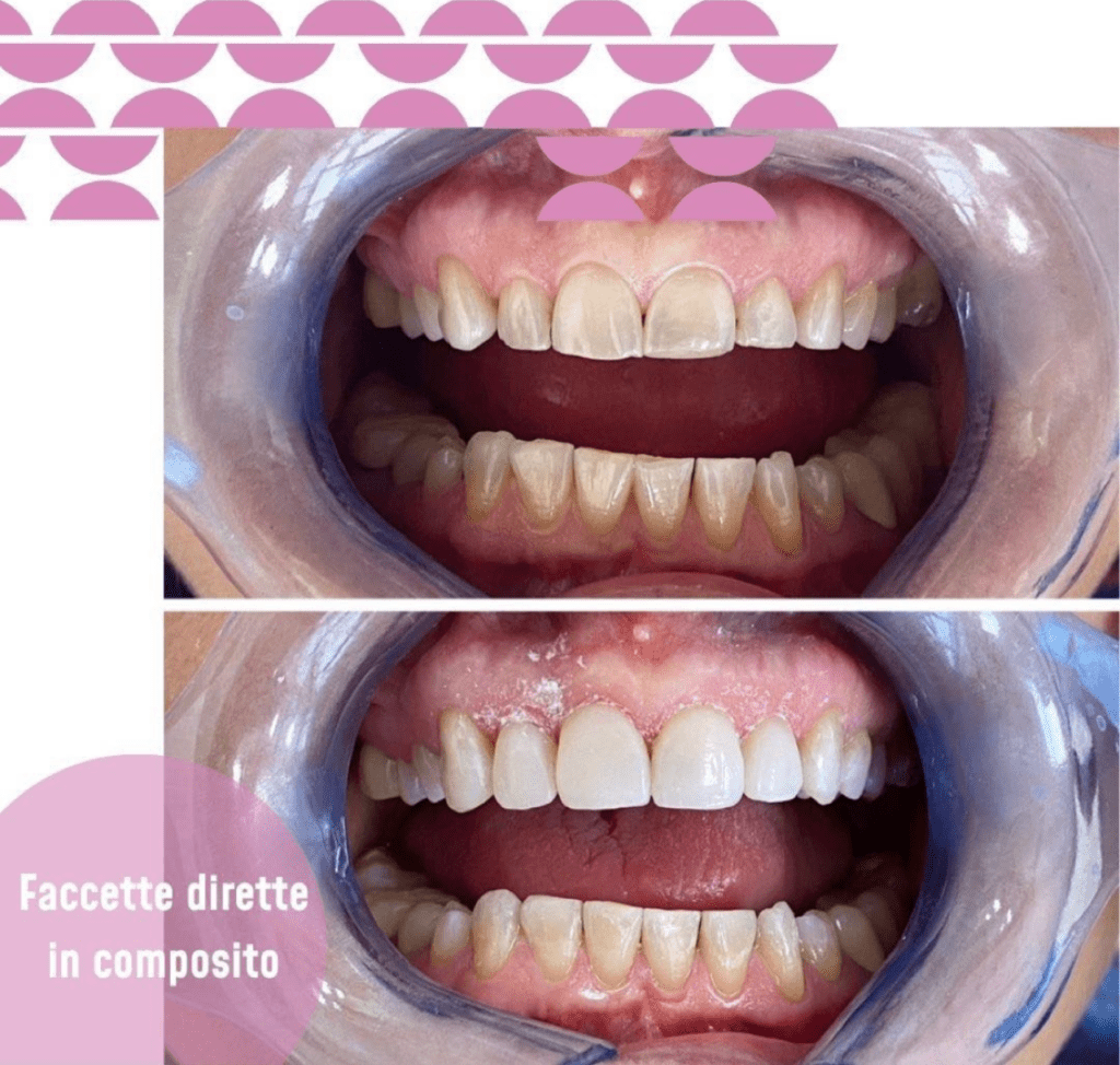 Agorà Medi - casi clinici faccette dentali, cosa sono le faccette dentali