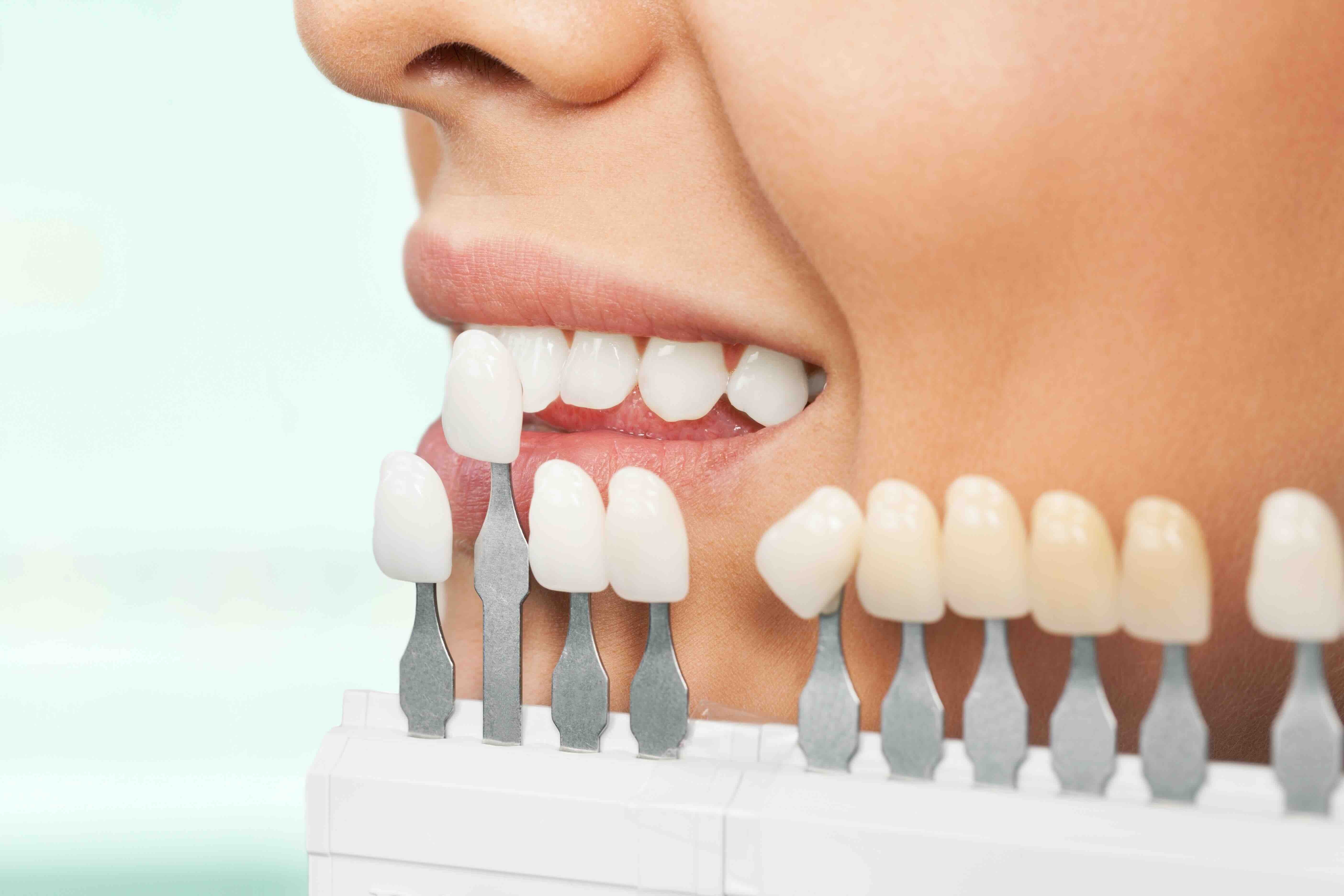 Quanto durano le faccette dentali