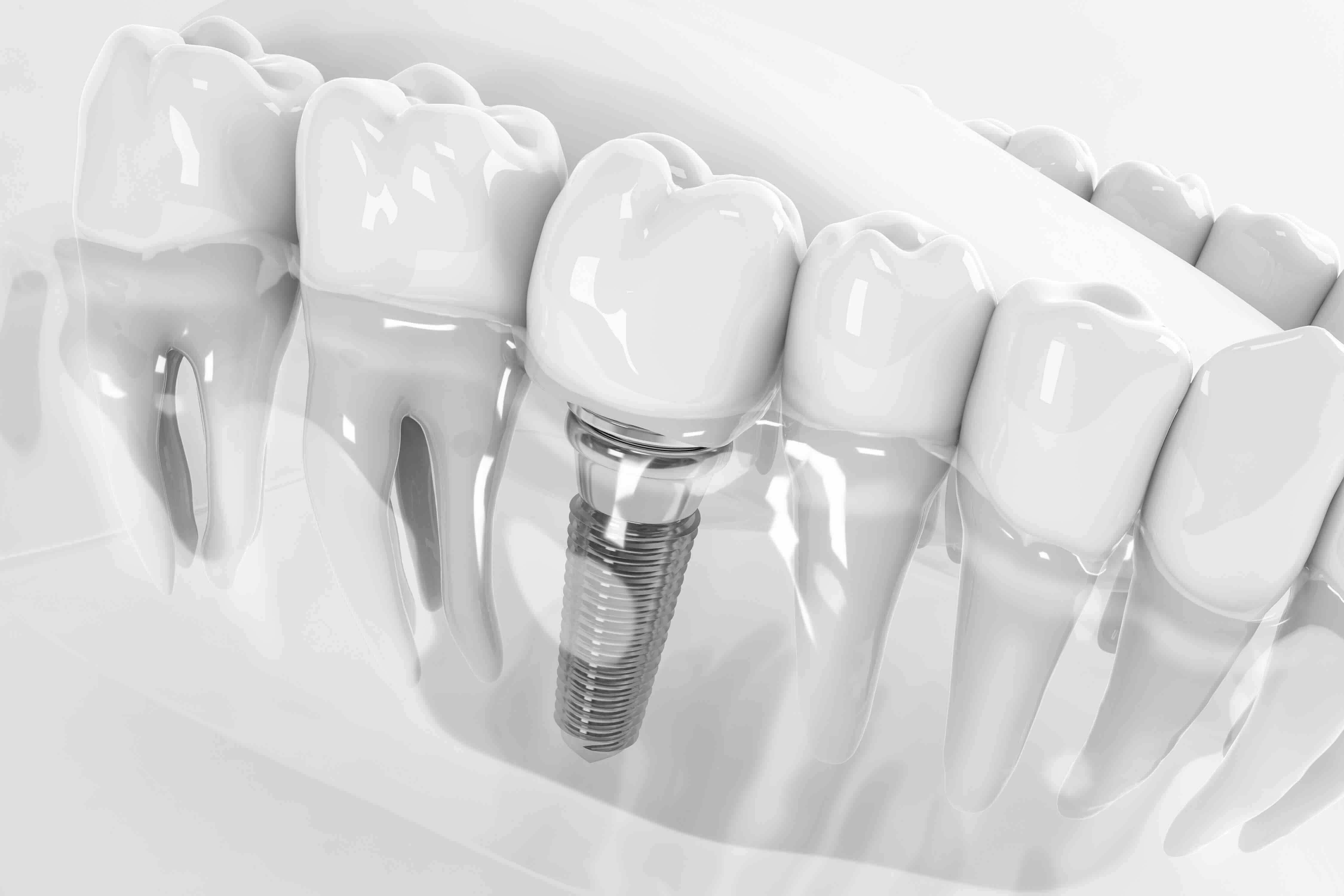 Quanto dura impianto dentale
