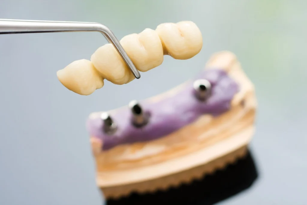implantologia dentale a Reggio Emilia