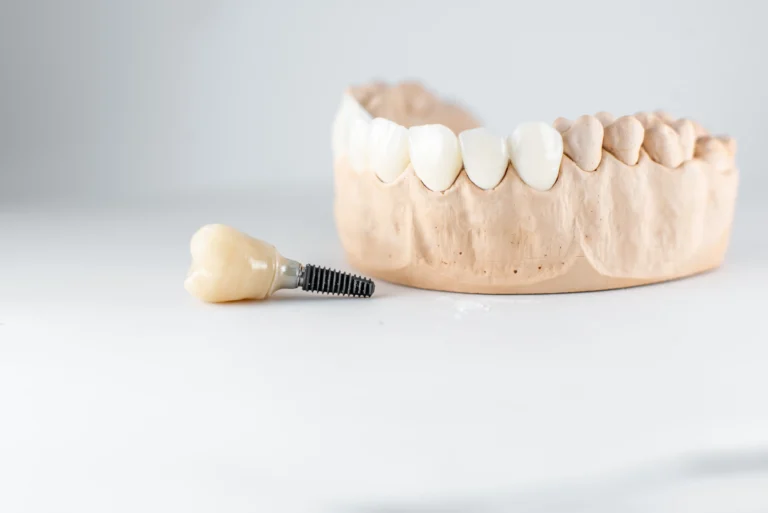 implantologia dentale a Reggio Emilia, impianto dentale a Reggio Emilia