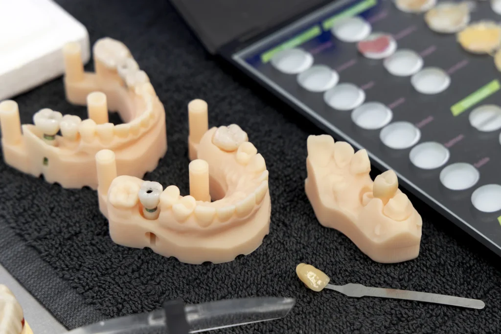 Differenza tra protesi mobile e impianto dentale